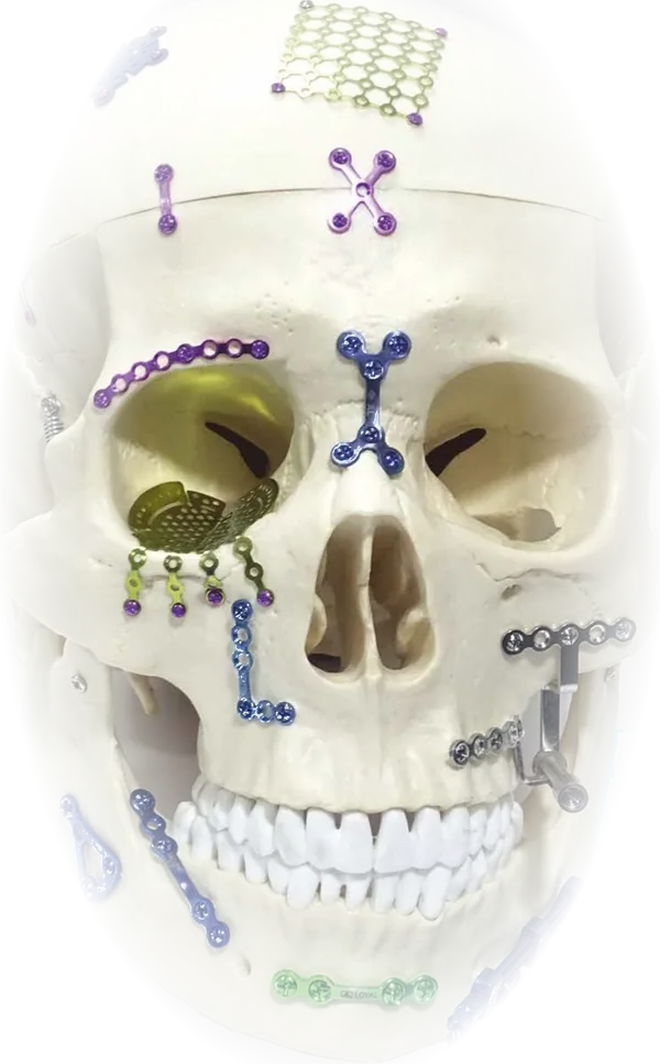 Anatomical skull fitted with anodised titanium plates, mesh and screws from the Loyal Surgicals range
